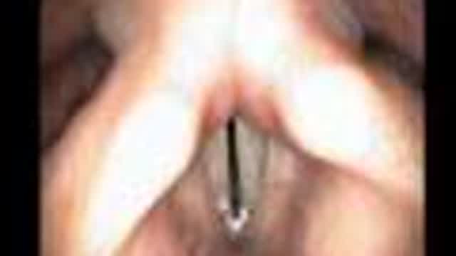 Video Stroboscopy of the Vocal Cords