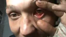 Schizophrenic thinks that he has a camera in his eye, so he try to take it out